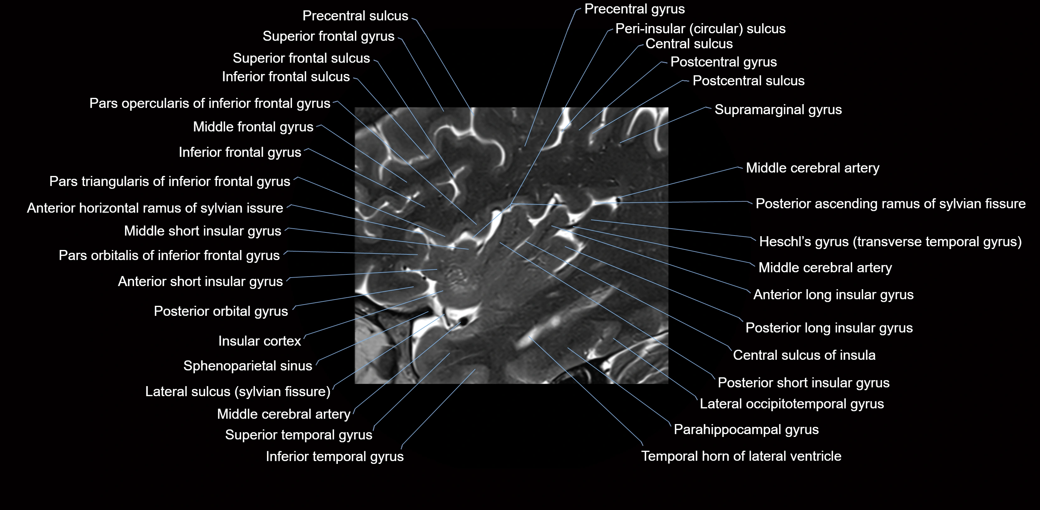 Insula cross section anatomy MRI sagittal 3t labelled image-img-00006.webp
